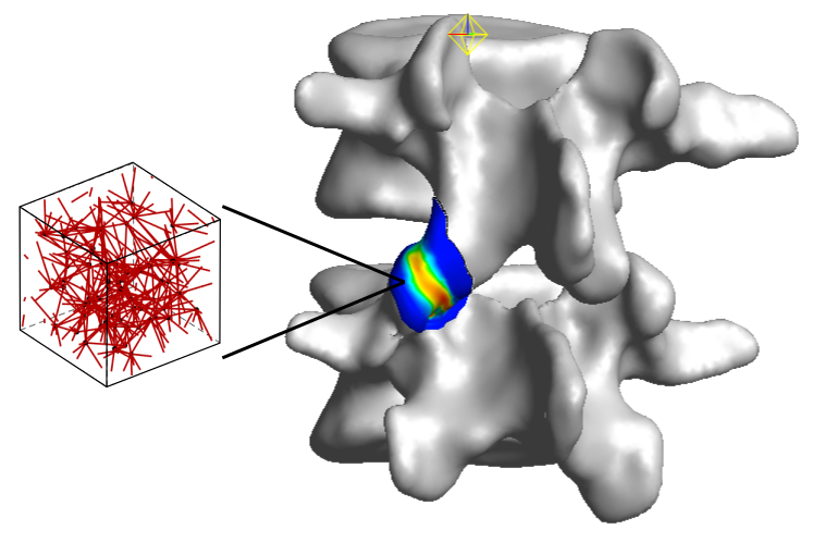 Vertebra strain with computer modeling overlay
